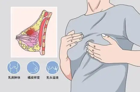 乳腺1.png