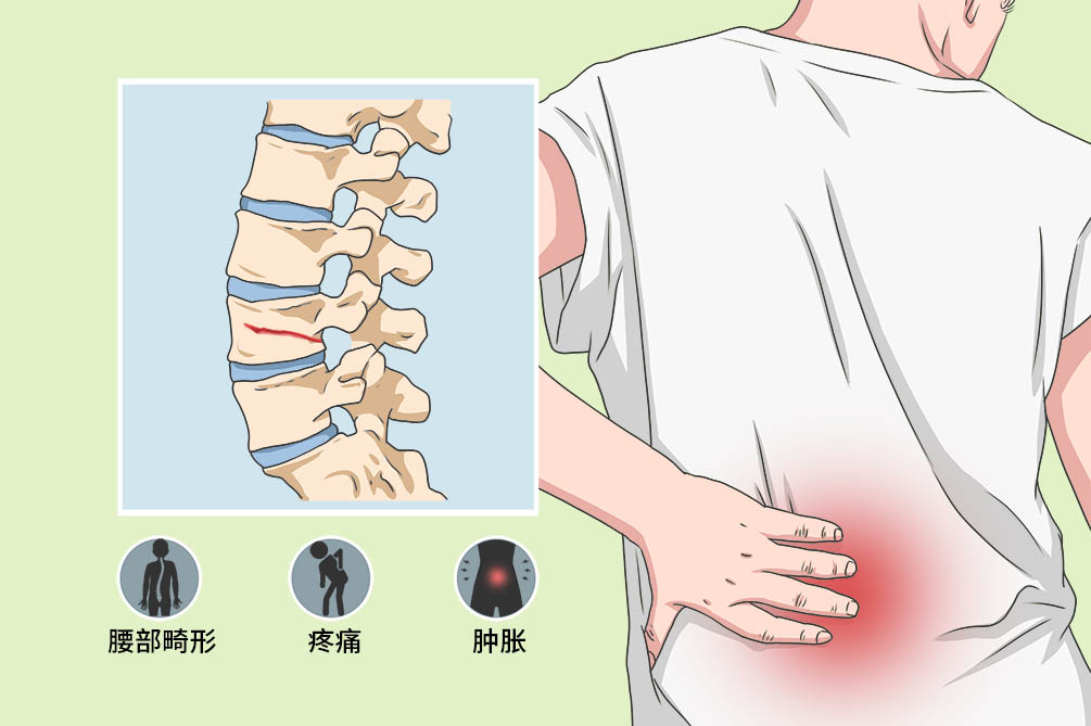 腰椎骨折卡通图片